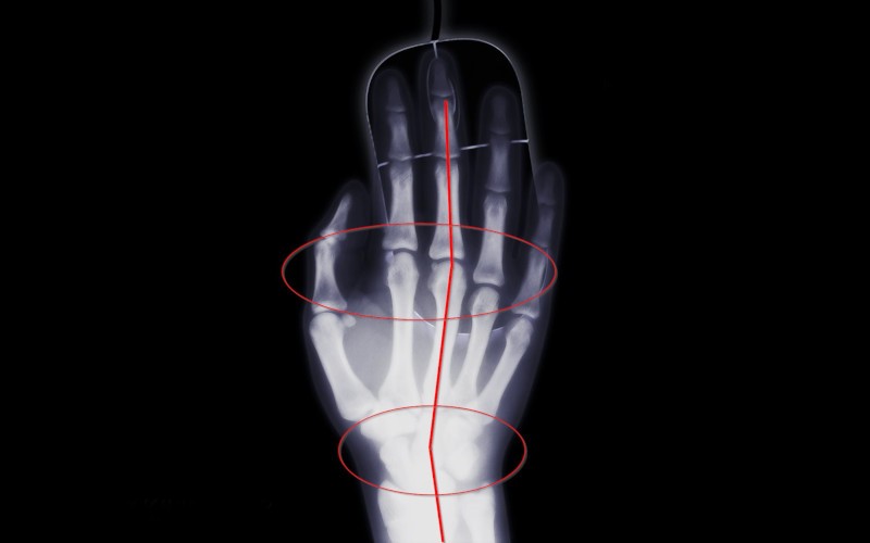 Az ergonomikus egér segít az egészség megőrzésében